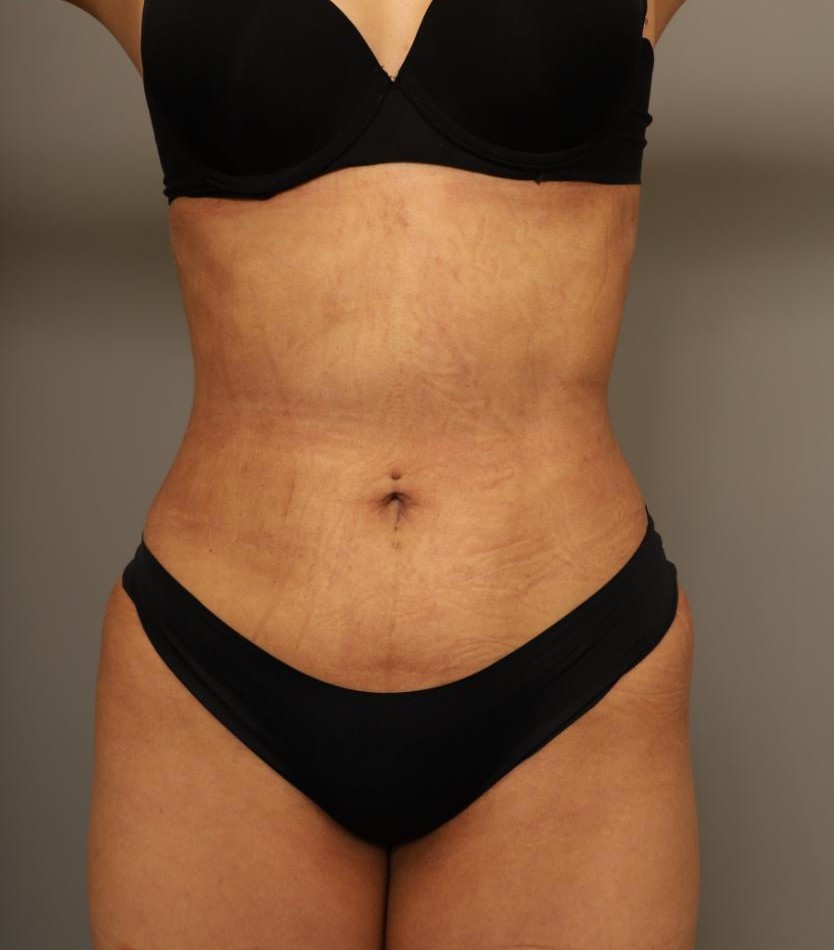 Bikini Remodeling-2