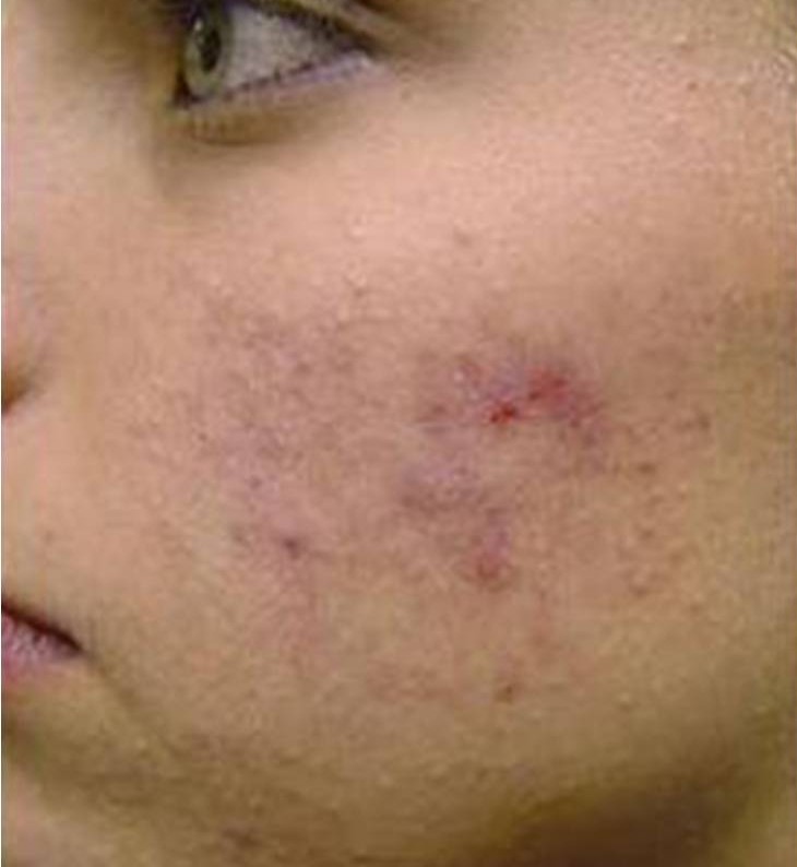 Chemical Peels-1