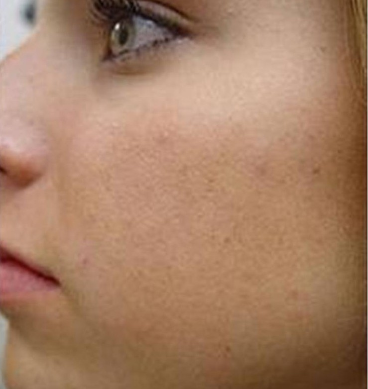 Chemical Peels-2