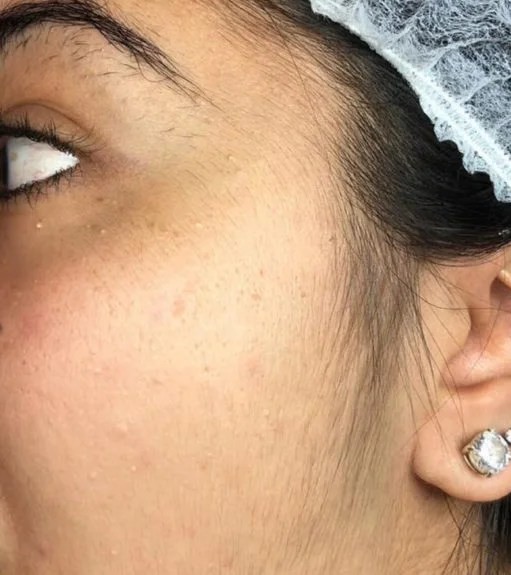 Dermaplaning-1