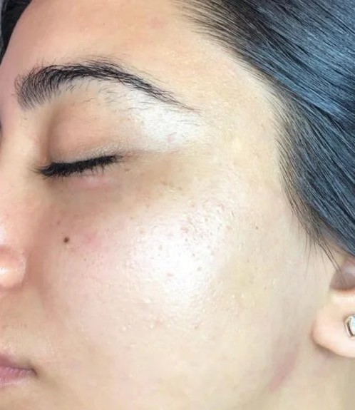 Dermaplaning-2