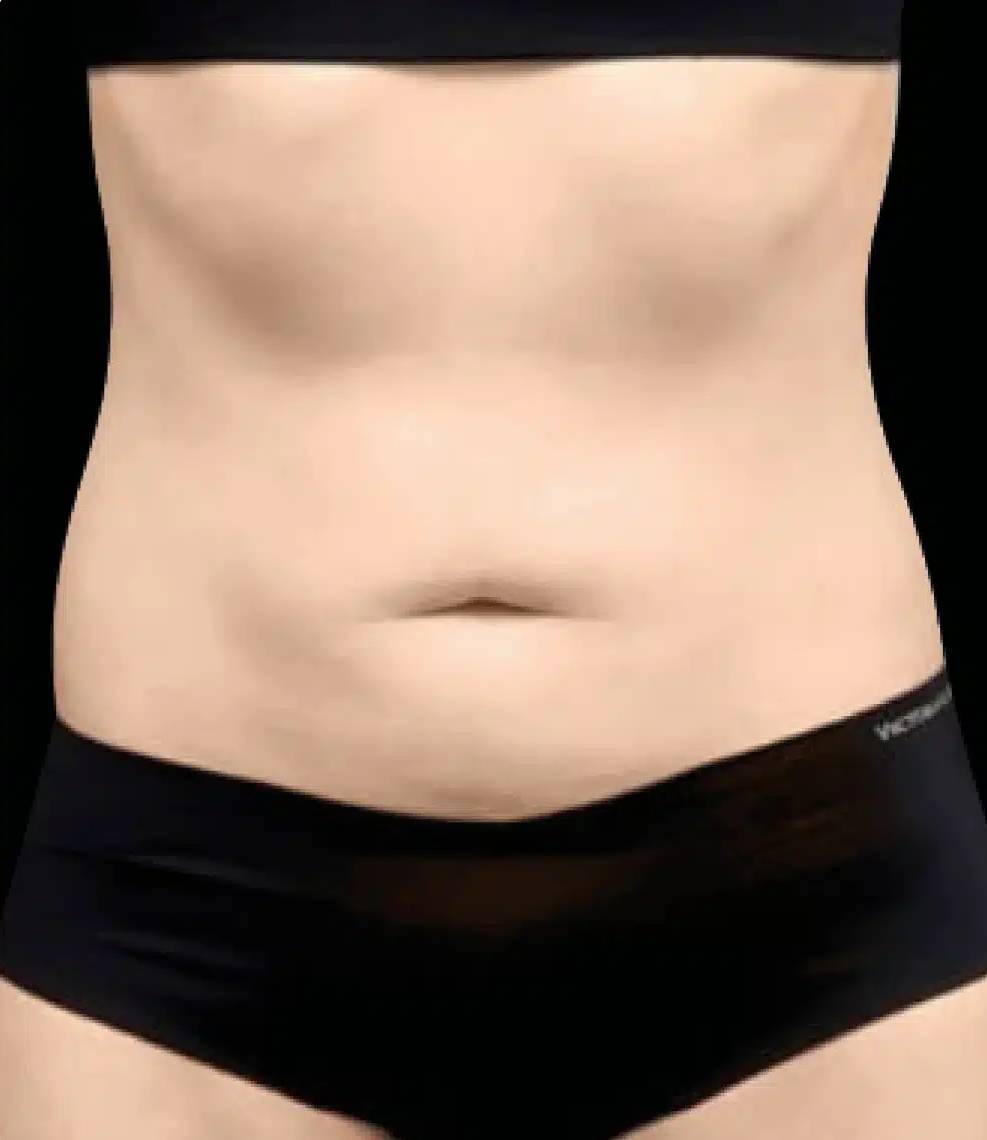 EMSculpt NEO-2