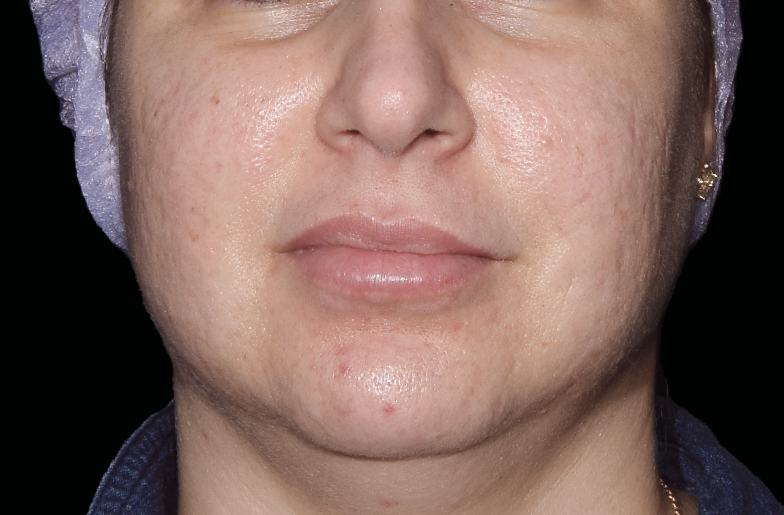 EXION RF Microneedling-1