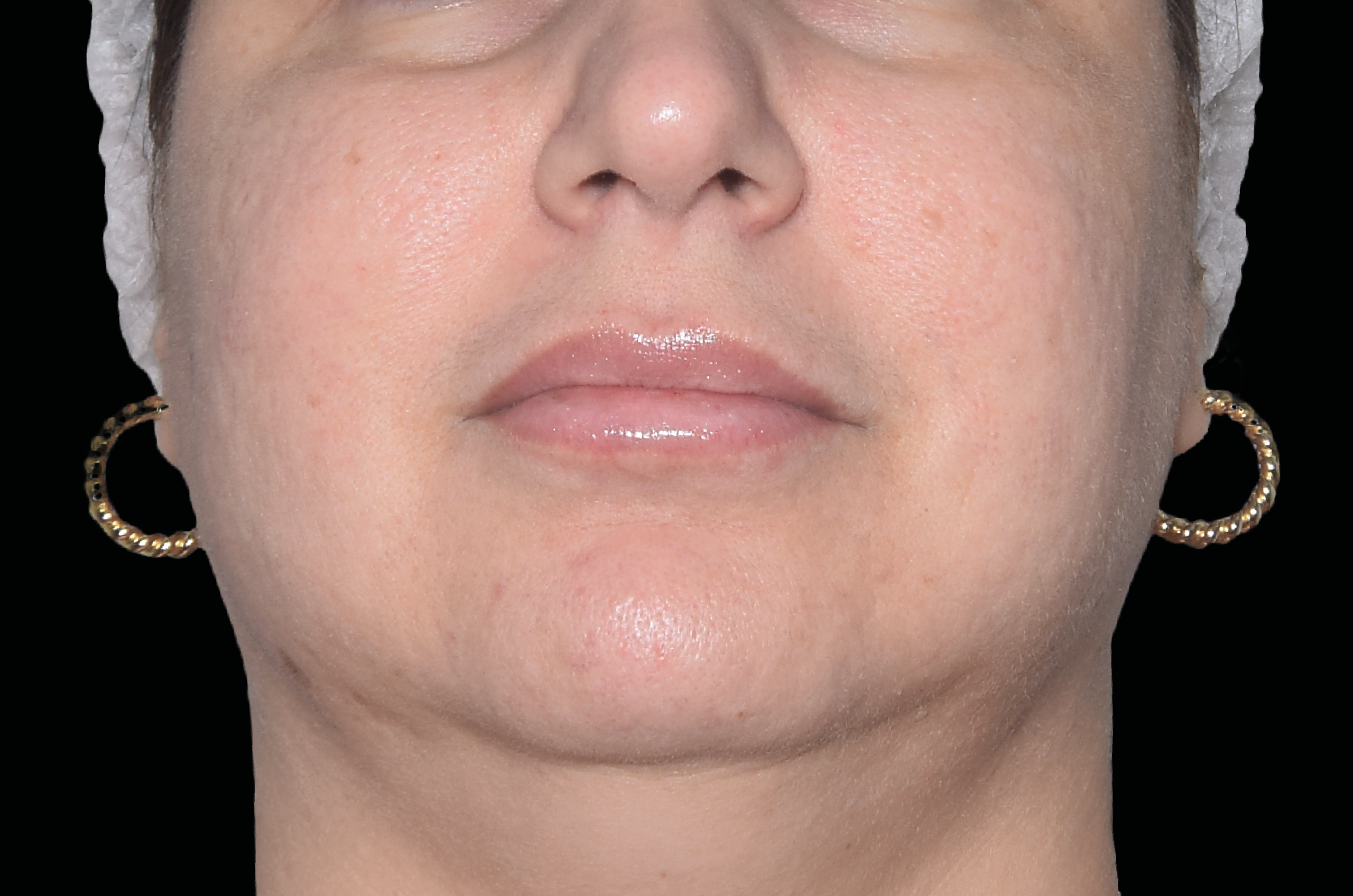 EXION RF Microneedling2