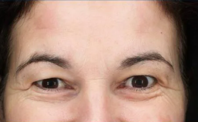 EndoLift1