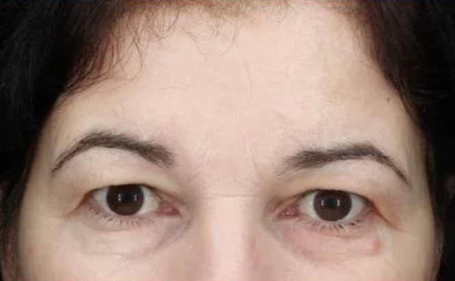 EndoLift2