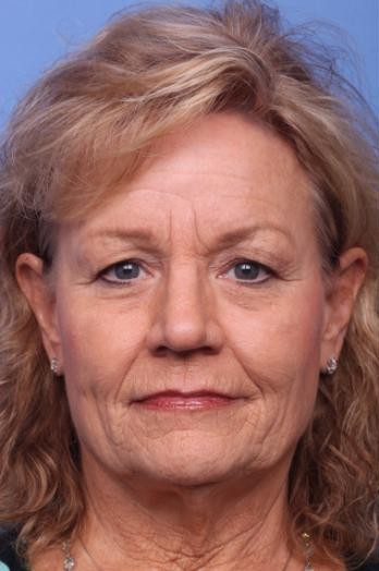 Full Face Lift1