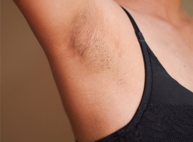 Laser Hair Removal in Dubai1