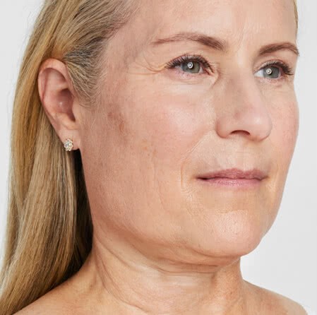 Ultherapy-1