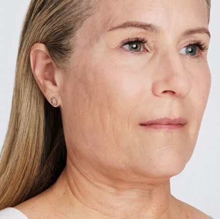 Ultherapy-2